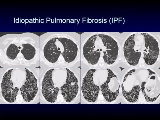 CHEST 2016 video sessions: HRCT of the chest