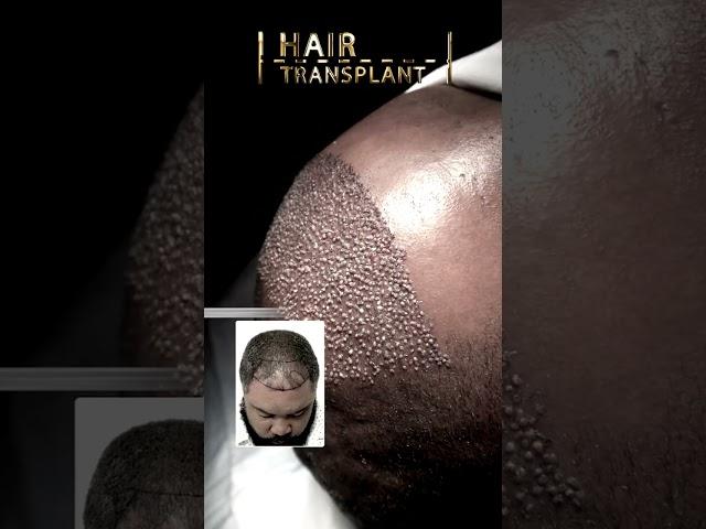 Hair Transplant | Care4Hair #beforeandafter