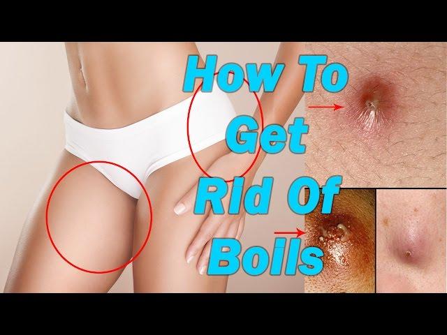 How To Get Rid Of Boils On Inner Thighs And Buttocks