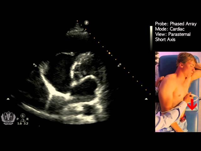 Parasternal Short Axis View - Transthoracic Echocardiography (Ultrasound)