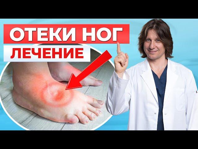 Что делать, если отекают ноги? 5 причин и способы лечения отека ног