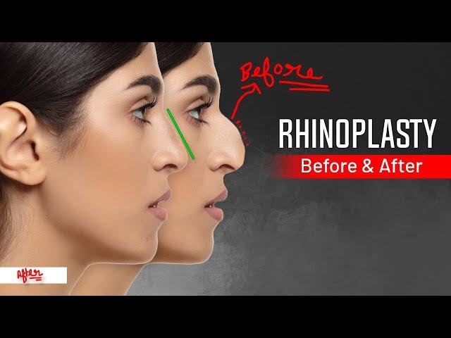 “What to Expect from Rhinoplasty: The Ultimate Guide”