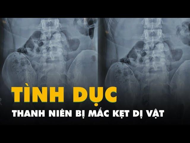 Thanh niên đi cấp cứu vì bị kẹt đồ chơi tình dục