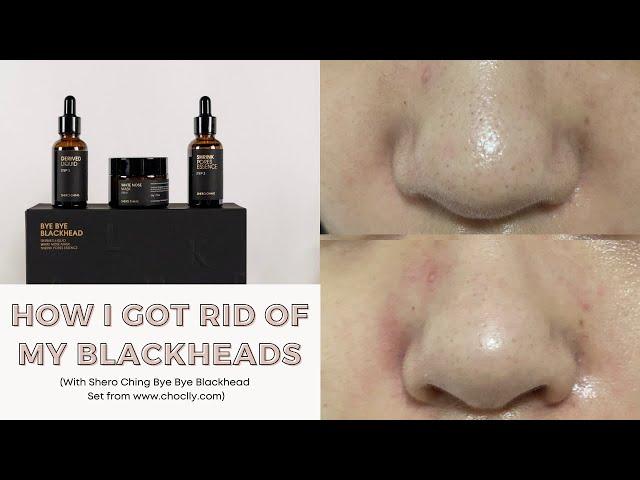 How I remove my stubborn blackheads with Shero Ching Bye Bye Blackhead set