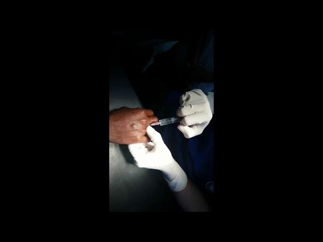 PIP joint dislocation, reduced under local anaesthesia, Adamya Hospital videos