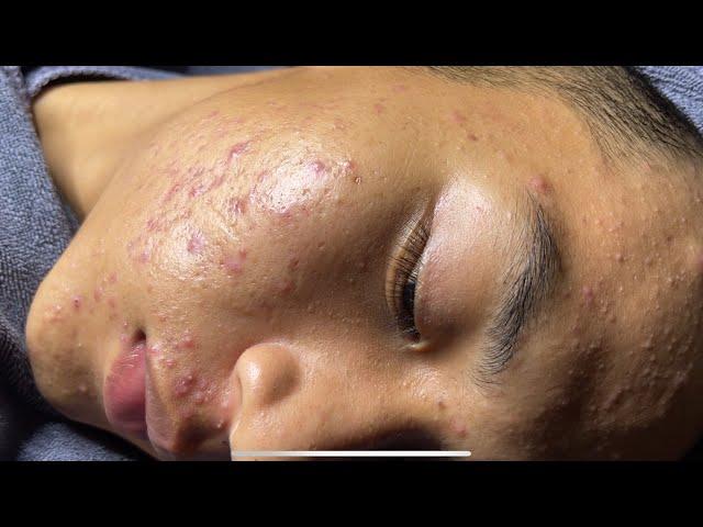 Blackheads & Pimples Pore Removal New 2024 | Acne Treatment With  Bo Nguyễn Spa