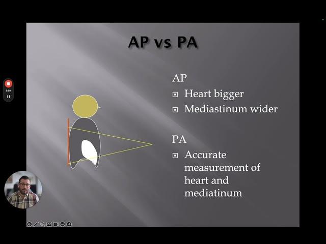 Understanding Radiology Terminology  - Chest X-Rays Part 2 of 4