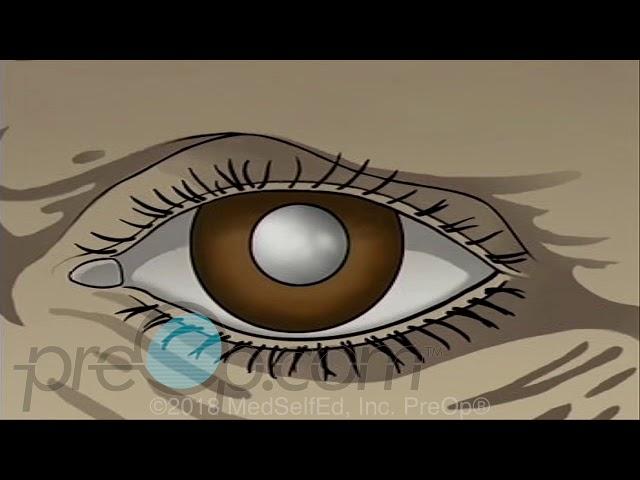 Cataract - Small Incision Surgery  PreOp® Patient Education and Engagement