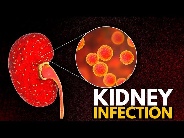 Kidney Infection, Causes, Signs and Symptoms, Diagnosis and Treatment.