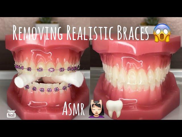 ASMR | Ortho Visit | Removing braces and placing lingual permanent retainer