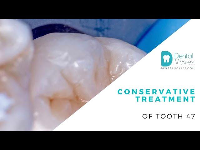 Conservative treatment of tooth 47