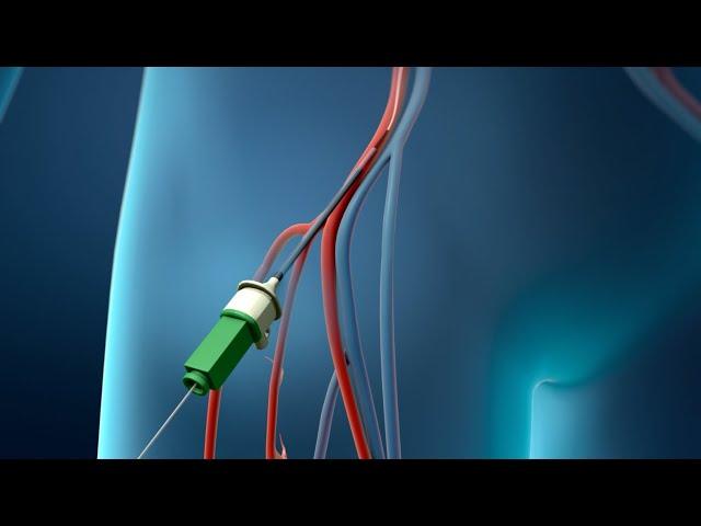 Coronary Angioplasty (Femoral Access)