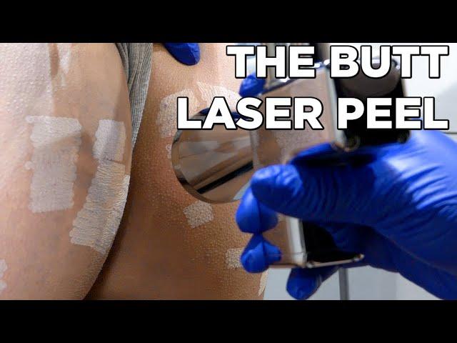 This butt laser peel corrects dark spots