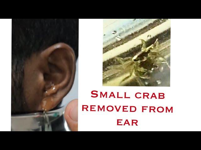 Crab inside ear / removed alive from ear