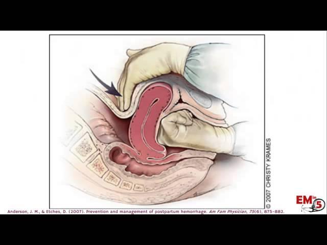 Postpartum Hemorrhage