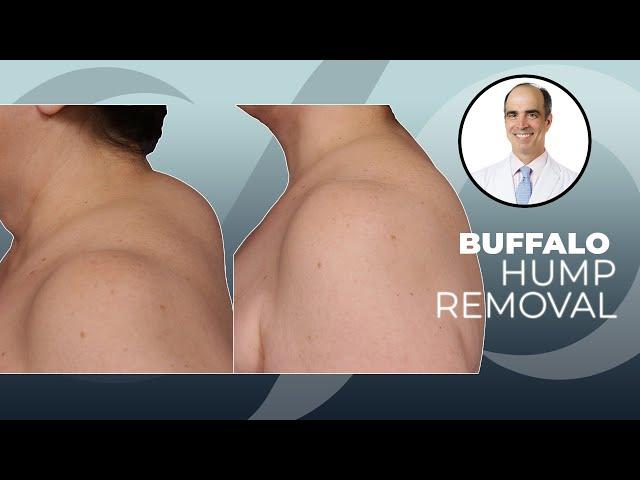 Buffalo Hump Removal: How To Rid Yourself of the Ugly Neck Hump