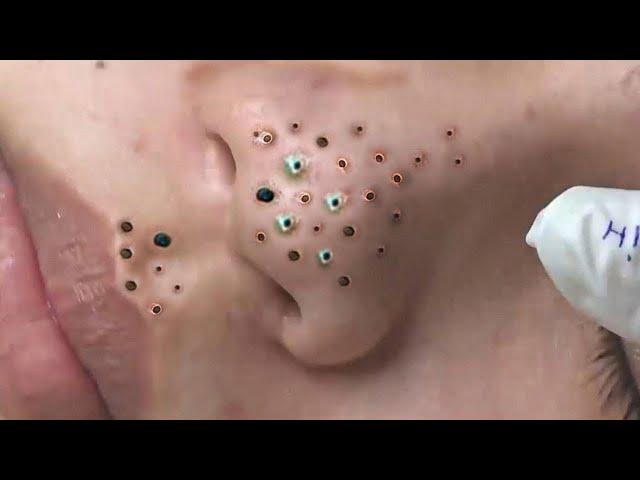 Big Cystic Acne Blackheads Extraction Blackheads & Milia, Whiteheads Removal Pimple Popping # 4677