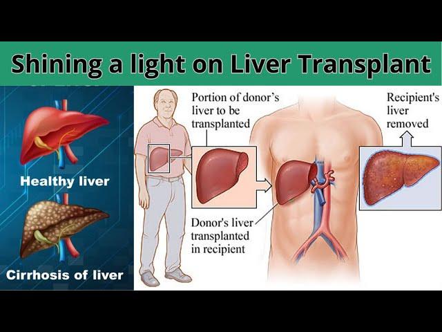 Shining a Light on Liver Transplant | Dania Medicare Solutions