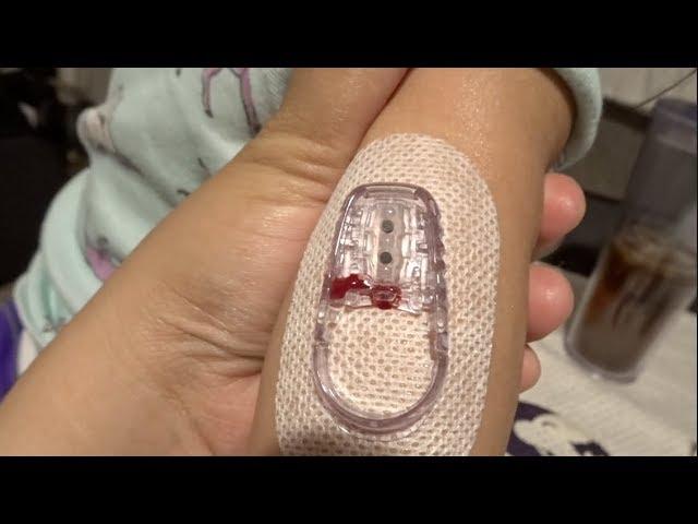 Dexcom G6 Insertion | We had a bleeder |  Type One Diabetes