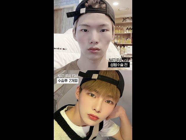 자연주의성형외과 남자눈성형+남자코성형+광대 수술전후 영상
