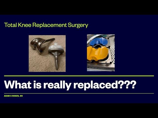 What is actually replaced when I have a knee replacement? Is the whole knee replaced? Steps of a TKA