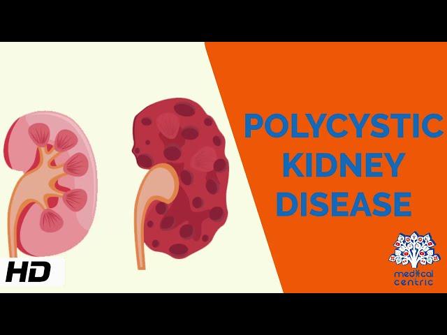 Polycystic kidney Disease, Causes, Signs and Symptoms, Diagnosis and Treatment.