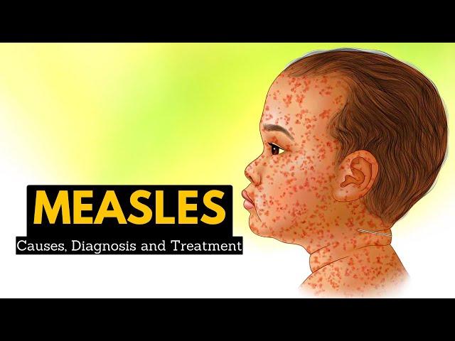 Measles, Causes, Signs and Symptoms, Diagnosis and Treatment.