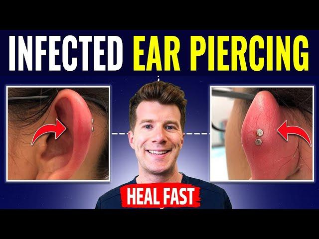 Doctor explains HOW TO RECOGNIZE AND TREAT INFECTED EAR PIERCING