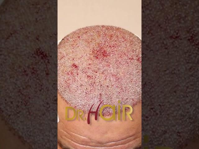 Dr.Hair: Clínica de Transplante Capilar FUE & DHI - Melhores Preços & Pacotes (Muriaé - MG)