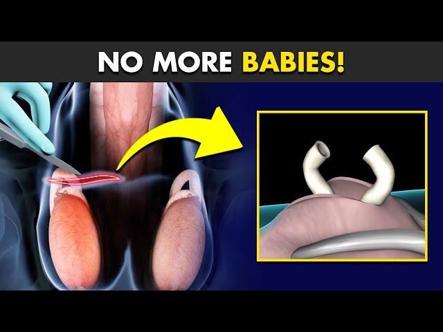 How Vasectomy Birth Control Surgery Is Performed? (3D Animation)