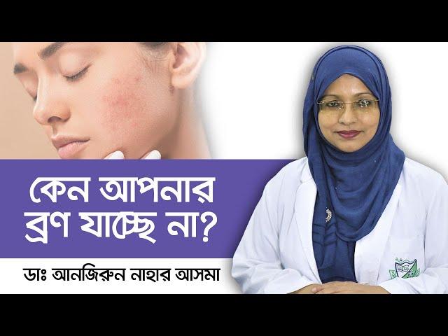 ব্রণ যাচ্ছে না কেন? - Pimple scars treatment - Scar on face treatment - ব্রণের দাগ