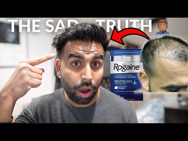 Does Rogaine Work? | My Biggest Regret 6 Years Later... ‍️