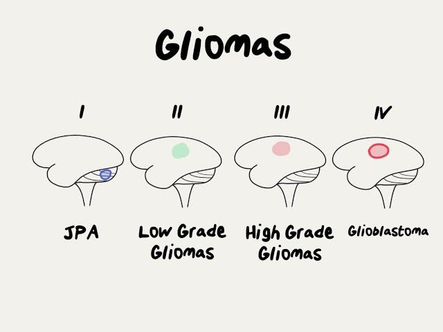 Doctor Explains Glioma Brain Tumor