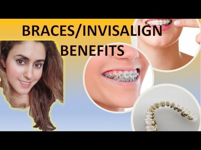 10 Surprising Benefits of Braces & Invisalign!