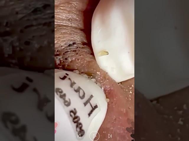 Skincare | Blackheads Removal #488 #tweezers skincare #blackheads blackheads
