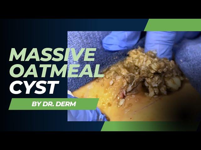 Massive Oatmeal Cyst with sack removal | Dr. Derm