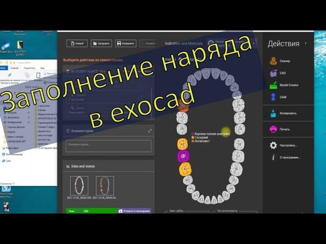 Этапы заполнения наряда в exocad. Цементный зазор.