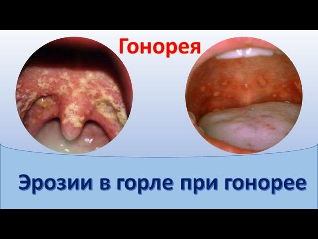 Эрозии в горле при гонорее