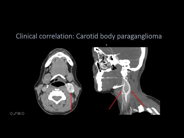 Imaging Head and neck spaces