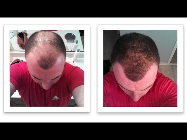 Smart Fix for Thinning Hair