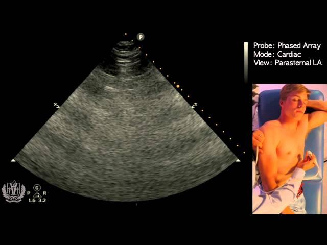 Parasternal Long Axis View - STEP by STEP Point of Care Ultrasound