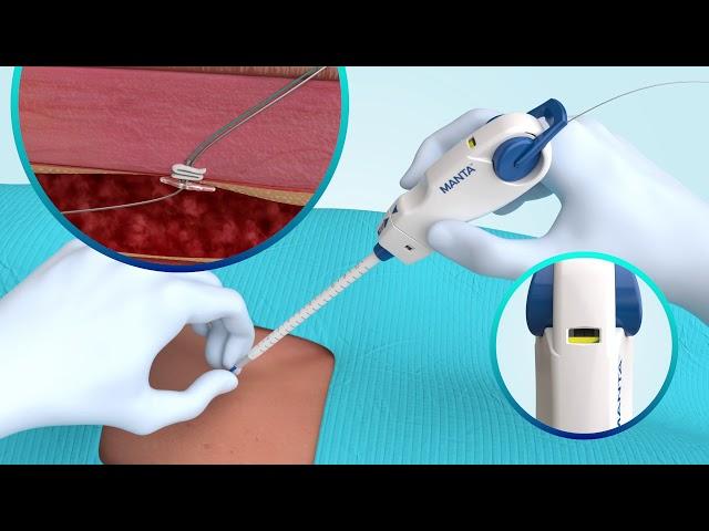 MANTA Vascular Closure Device Animation