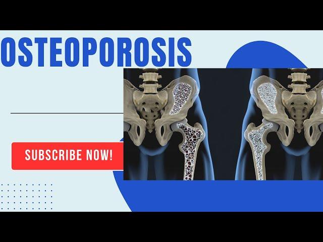 Osteoporosis