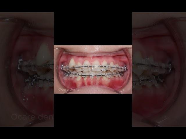 Niềng răng giữ răng khểnh #braces #orthodontist #niengrang