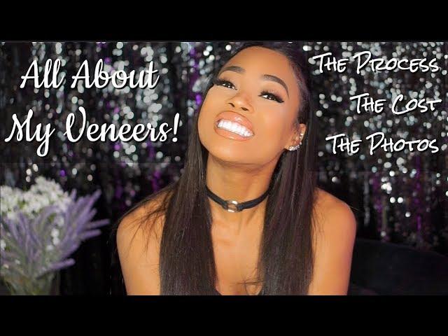 All About My Veneers!!!