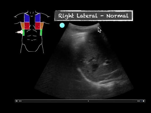 POCUS - Teaching Point - Ultrasound vs CXR in pneumonia