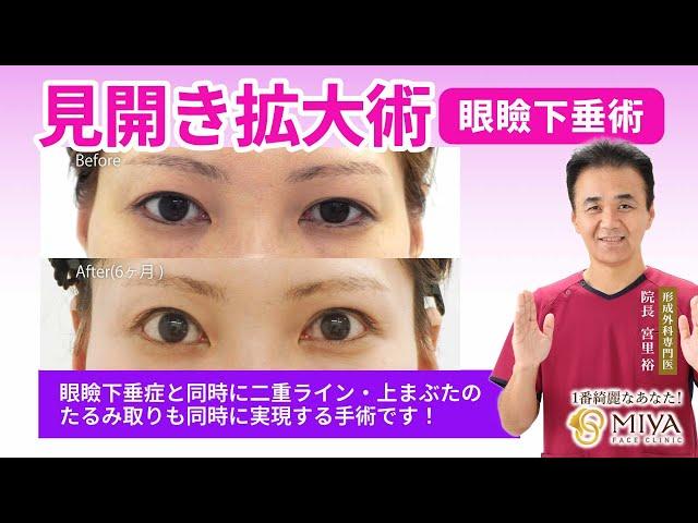 【目を大きく！見開きを拡大】見開き拡大術(眼瞼下垂術)の施術と症例／MIYAフェイスクリニック