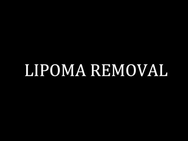 LIPOMA REMOVAL