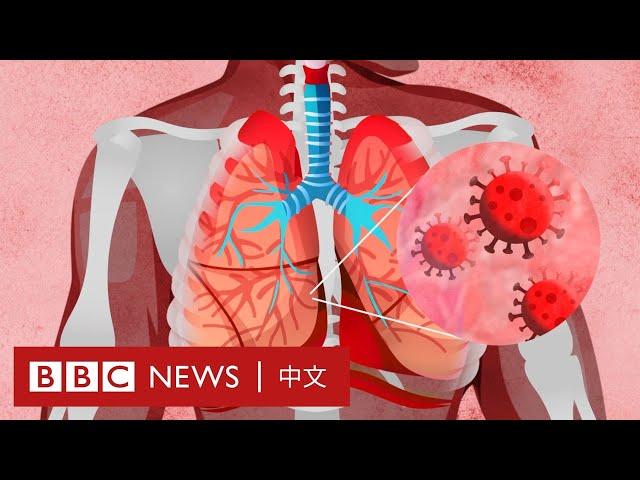 肺炎疫情：新冠病毒如何影響我們的身體？－ BBC News 中文