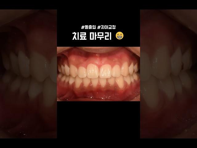 교정하면 생기는 변화 #돌출입 #치아교정